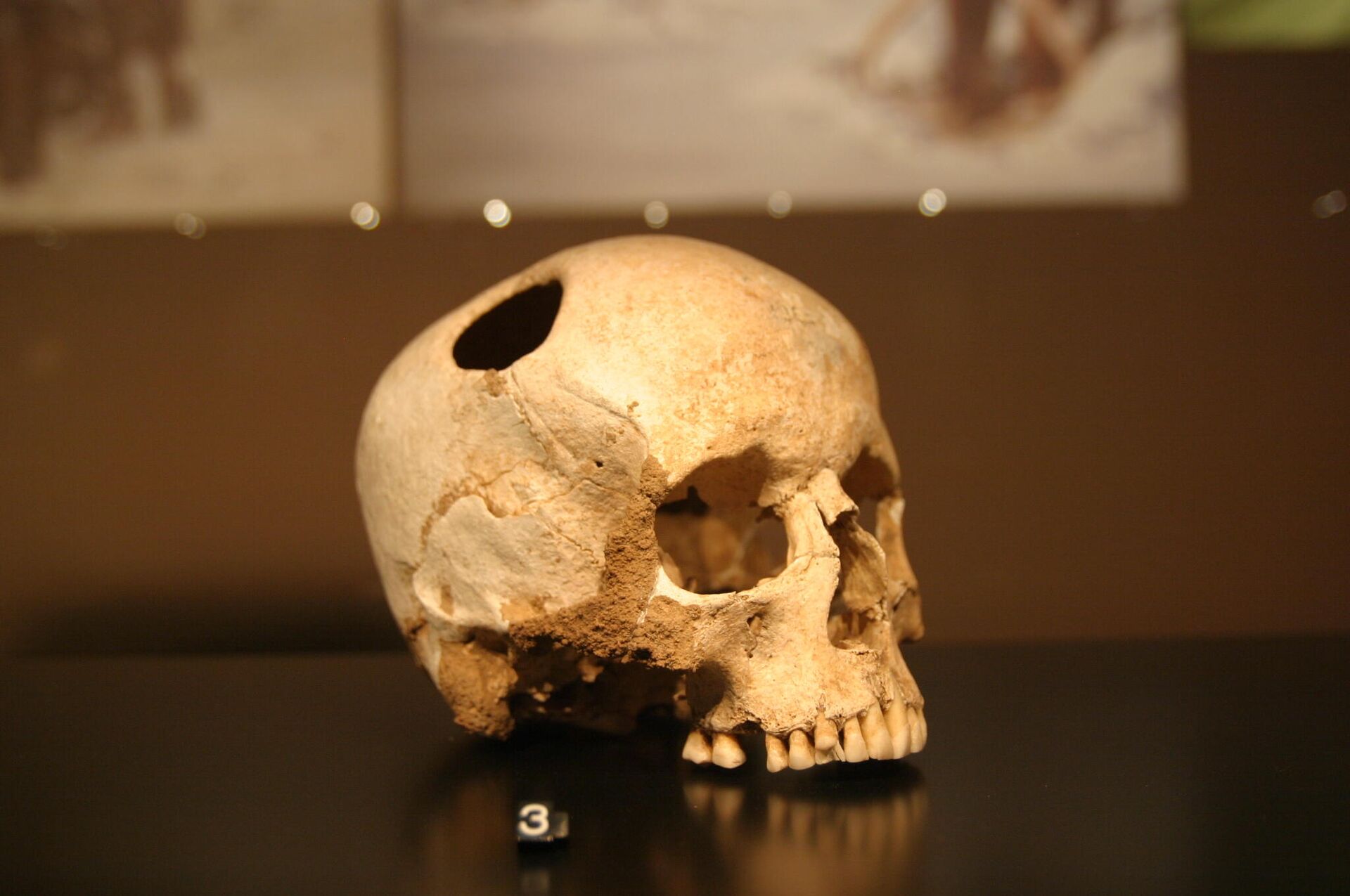 Тайна древних хирургов: зачем наши предки сверлили черепа наживую