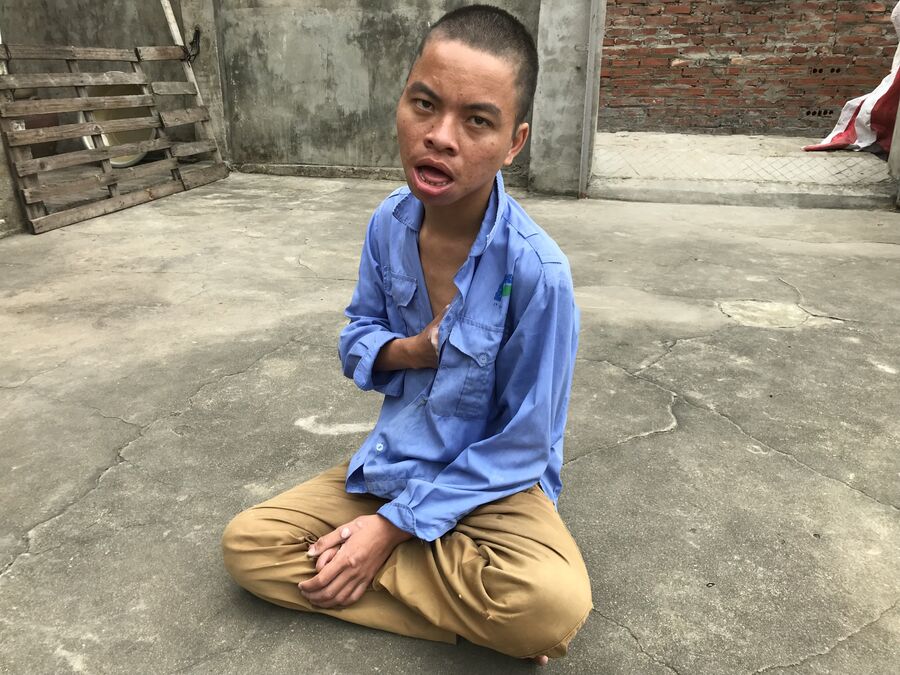 Фам Бао, сын Фам Тхи Ханг, жертва Агента Оранж