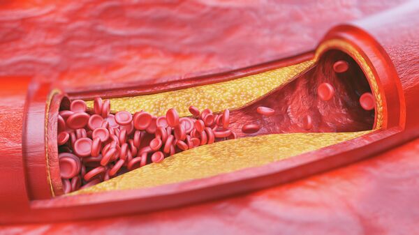 Имплант сосуда 