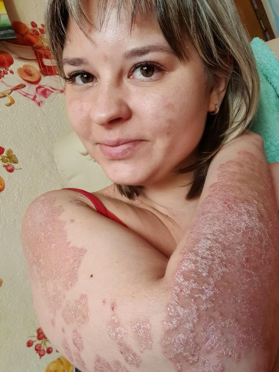 У Александры Ситдековой псориазом поражено 80 процентов кожных покровов У Александры Ситдековой псориазом поражено 80 процентов кожных покровов